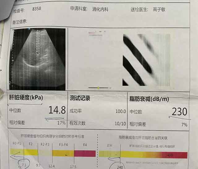 郑州看肝硬化哪个医院好?郑州哪个医生看肝硬化