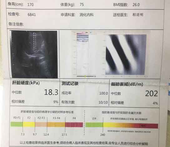 郑州治肝硬化有哪些好医院?郑州看肝硬化效果好医院