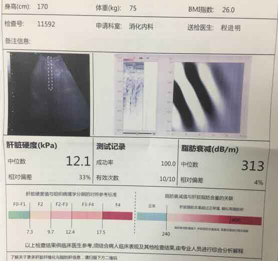 郑州治肝硬化有哪些好医院?郑州看肝硬化效果好医院