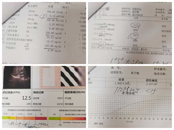 郑州看乙肝比较好的医院是哪家