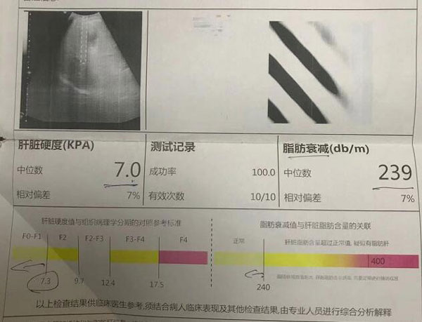 郑州看肝硬化到郑州哪家肝病医院好